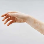 Vitiligo Tedavisinde En Güncel Yöntemler Nelerdir?