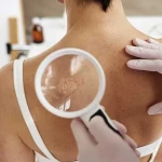 Vitiligo ve Deri Kanseri Riski Arasında Bağlantı Var mı?
