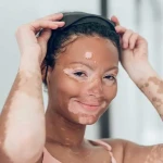 Common Body Areas Affected by Vitiligo